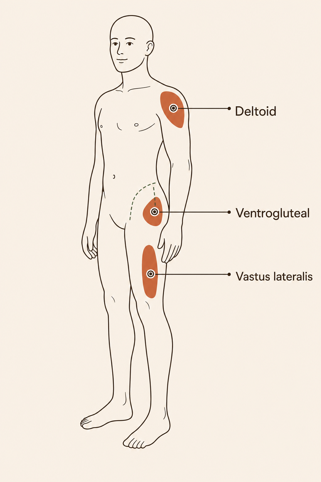 Intramuscular injection sites: deltoid, ventrogluteal, vastus lateralis